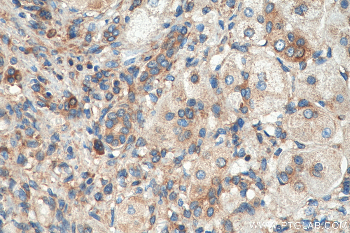 Immunohistochemistry (IHC) staining of human liver cancer tissue using FARSA Monoclonal antibody (67945-1-Ig)