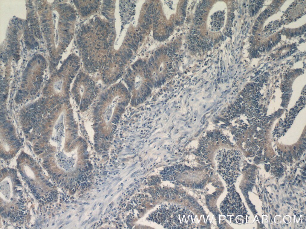 IHC staining of human colon cancer using 13098-1-AP