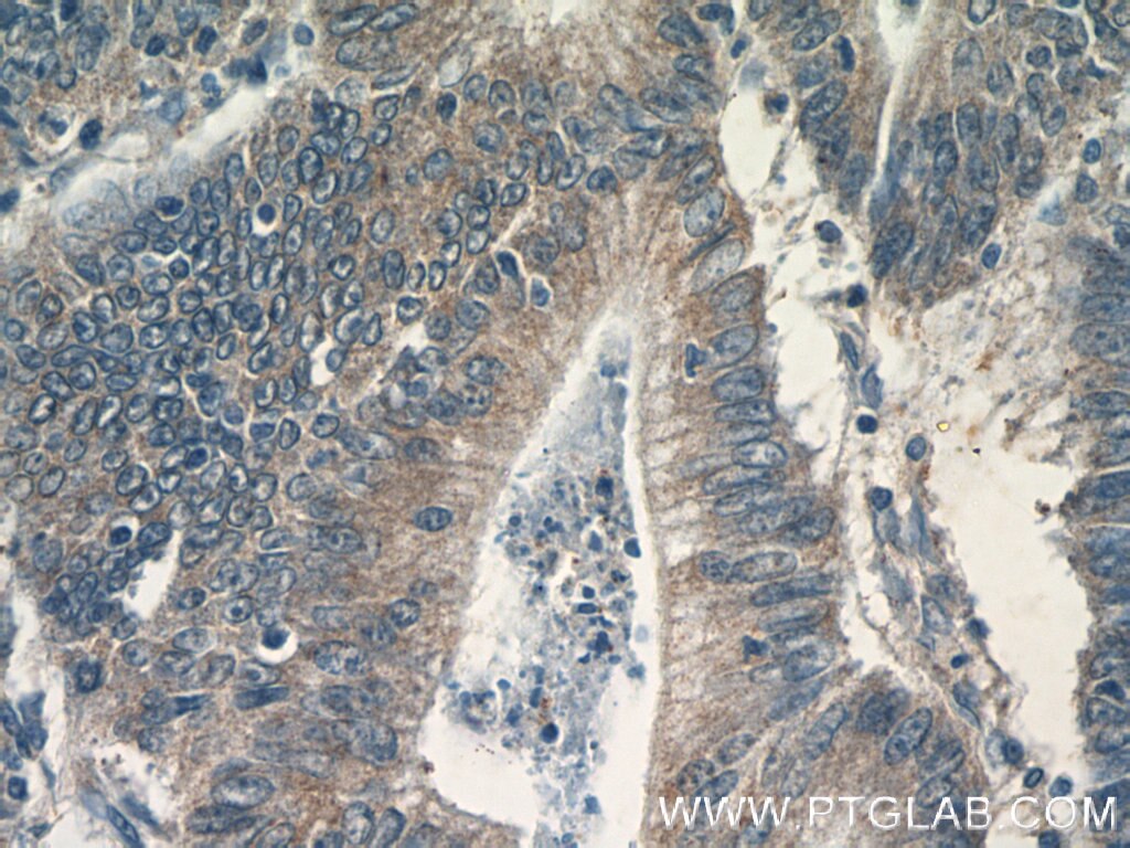 IHC staining of human colon cancer using 13098-1-AP