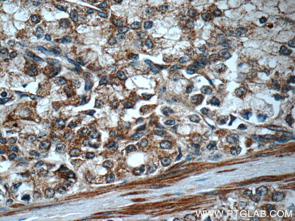IHC staining of human prostate cancer using 13098-1-AP