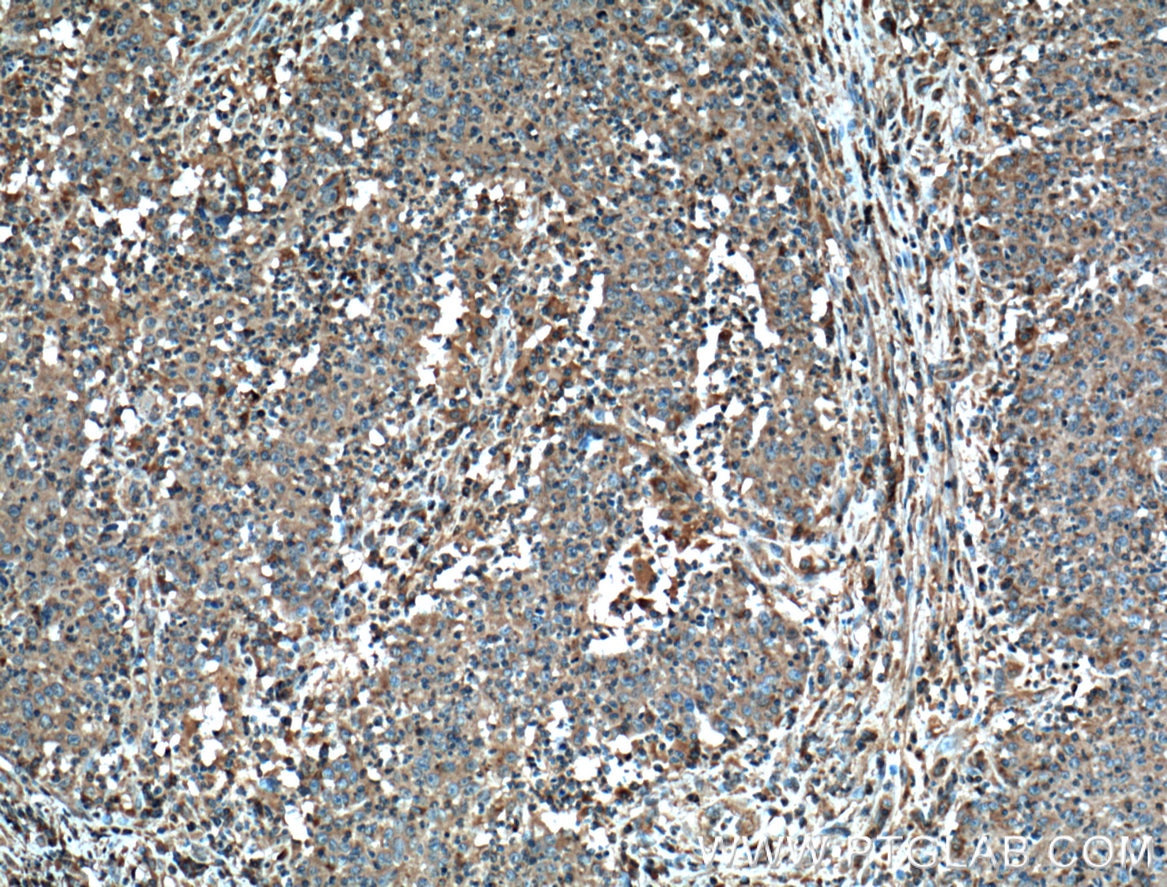 Immunohistochemistry (IHC) staining of human colon cancer tissue using FAS/CD95 Monoclonal antibody (60196-1-Ig)