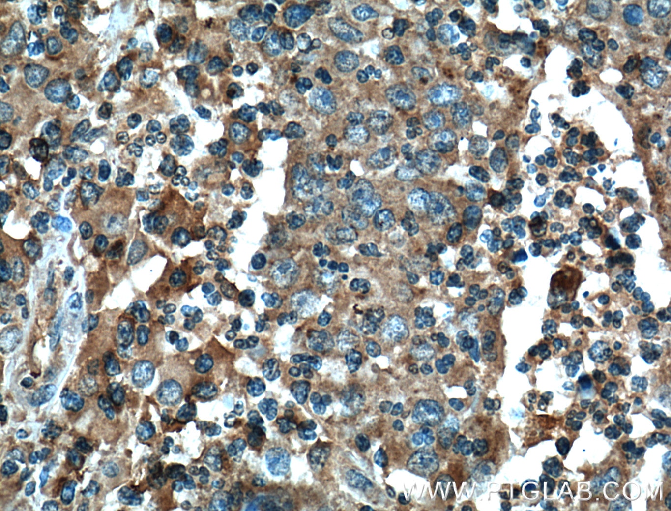 Immunohistochemistry (IHC) staining of human colon cancer tissue using FAS/CD95 Monoclonal antibody (60196-1-Ig)