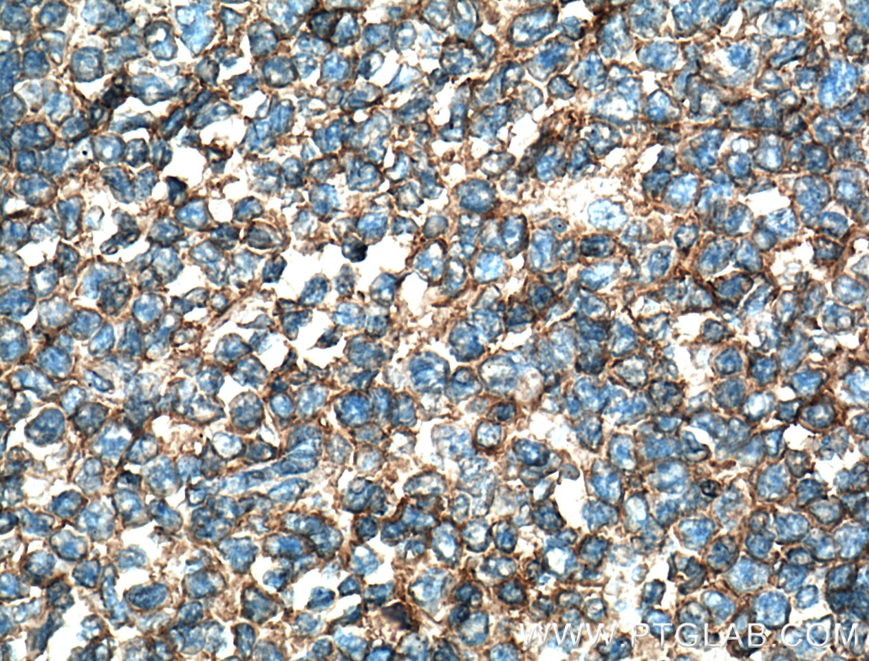 Immunohistochemistry (IHC) staining of human tonsillitis tissue using FAS/CD95 Monoclonal antibody (60196-1-Ig)