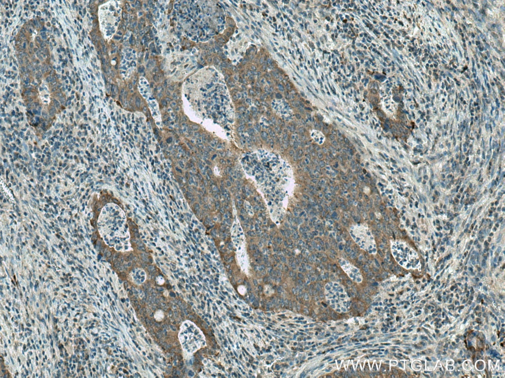 Immunohistochemistry (IHC) staining of human colon cancer tissue using FASN Polyclonal antibody (10624-2-AP)