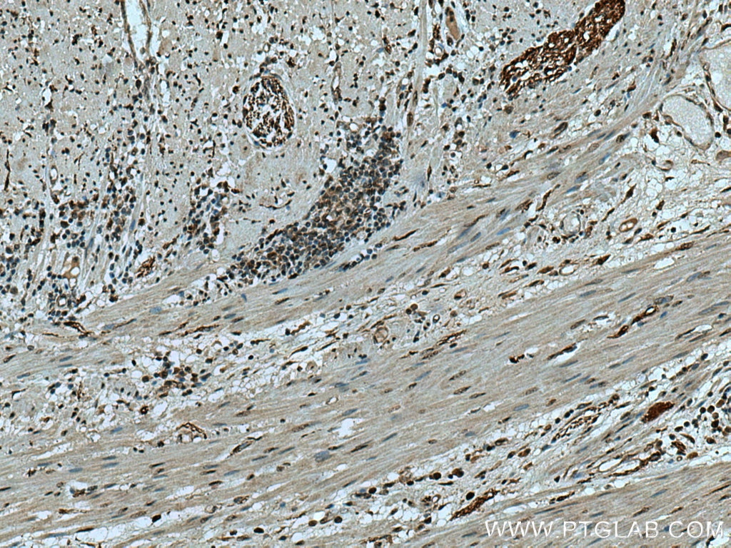 Immunohistochemistry (IHC) staining of human colon cancer tissue using FASN Polyclonal antibody (10624-2-AP)