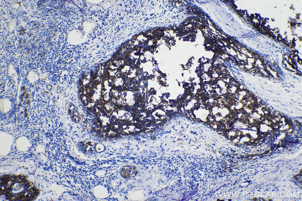 Immunohistochemistry (IHC) staining of human breast cancer tissue using FASN Polyclonal antibody (10624-2-AP)