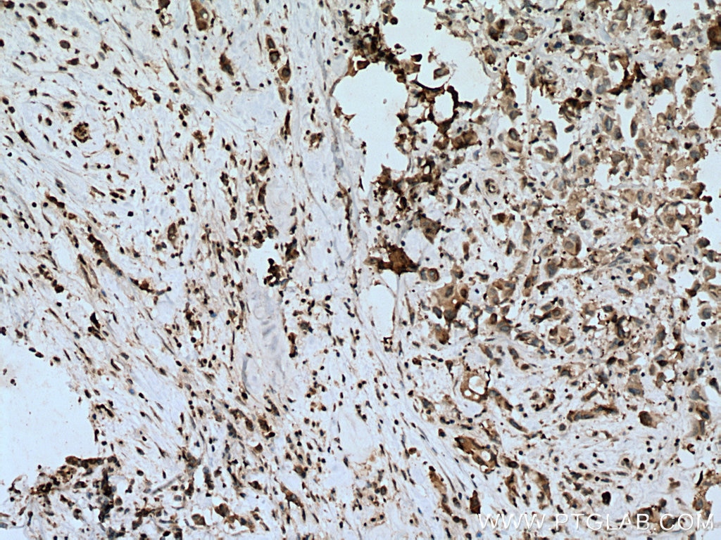 Immunohistochemistry (IHC) staining of human breast cancer tissue using FASN Monoclonal antibody (66591-1-Ig)