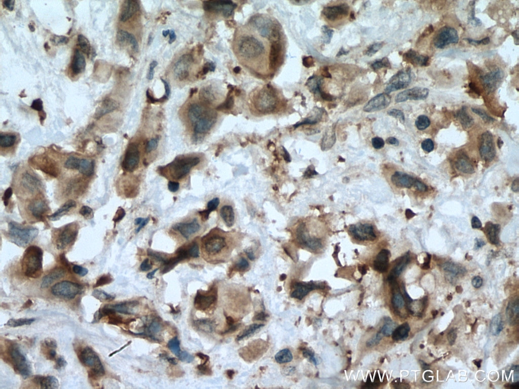 Immunohistochemistry (IHC) staining of human breast cancer tissue using FASN Monoclonal antibody (66591-1-Ig)