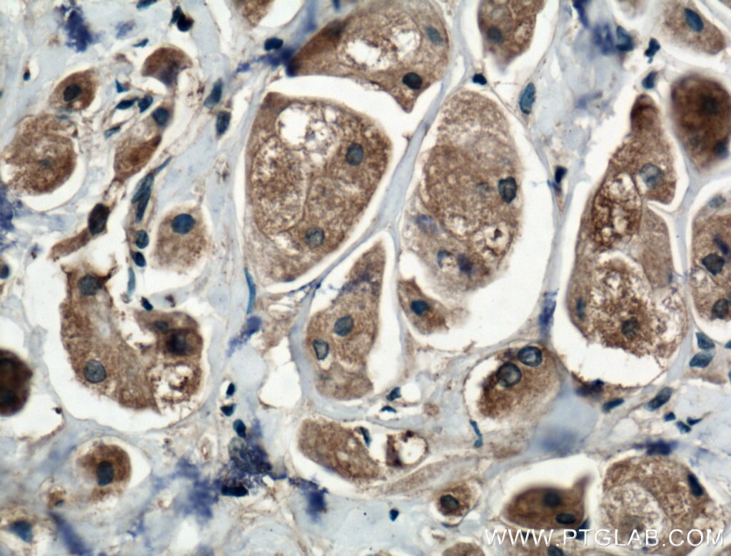 IHC staining of human breast cancer using 18392-1-AP