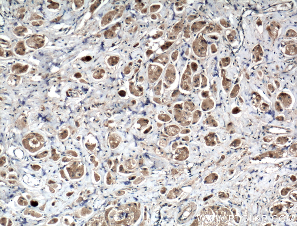 Immunohistochemistry (IHC) staining of human breast cancer tissue using FASTKD3 Polyclonal antibody (18392-1-AP)
