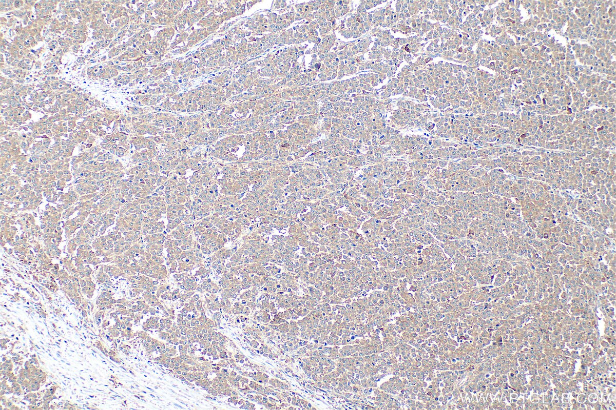 IHC staining of human colon cancer using 33468-1-AP (same clone as 33468-1-PBS) Immunohistochemistry (IHC) staining of human colon cancer tissue using FAT4 Polyclonal antibody (33468-1-AP)