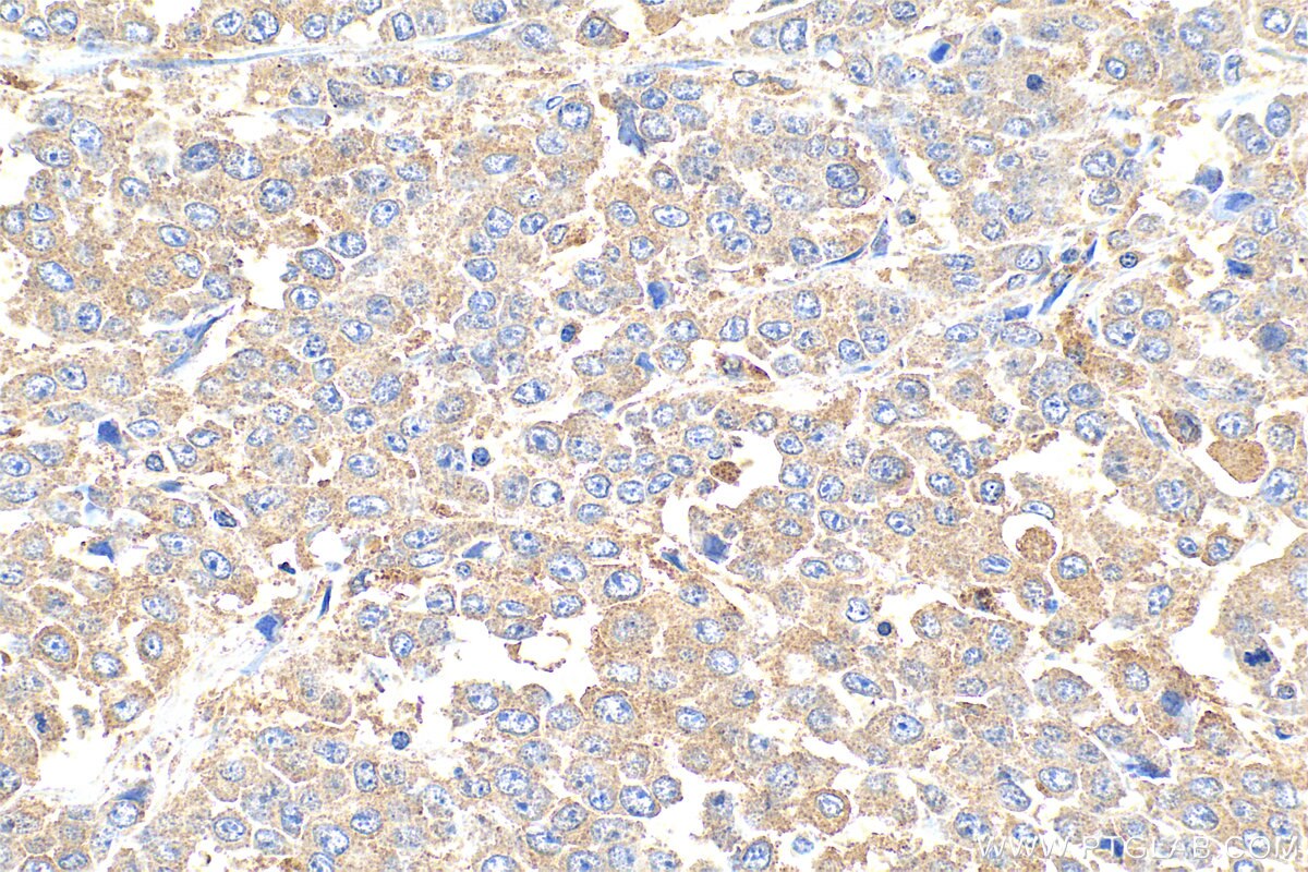 IHC staining of human colon cancer using 33468-1-AP (same clone as 33468-1-PBS) Immunohistochemistry (IHC) staining of human colon cancer tissue using FAT4 Polyclonal antibody (33468-1-AP)
