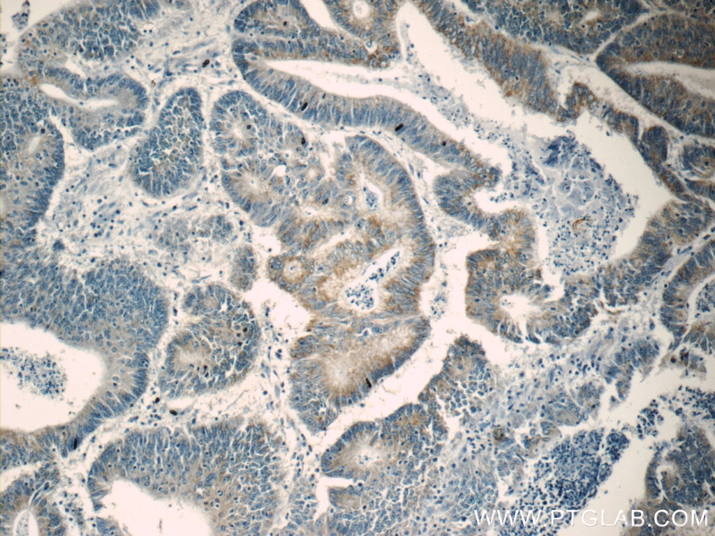 Immunohistochemistry (IHC) staining of human colon cancer tissue using FAU Polyclonal antibody (13581-1-AP)