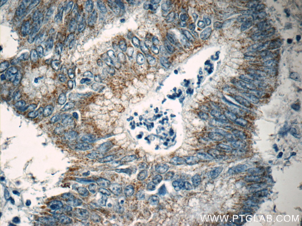 Immunohistochemistry (IHC) staining of human colon cancer tissue using FAU Polyclonal antibody (13581-1-AP)