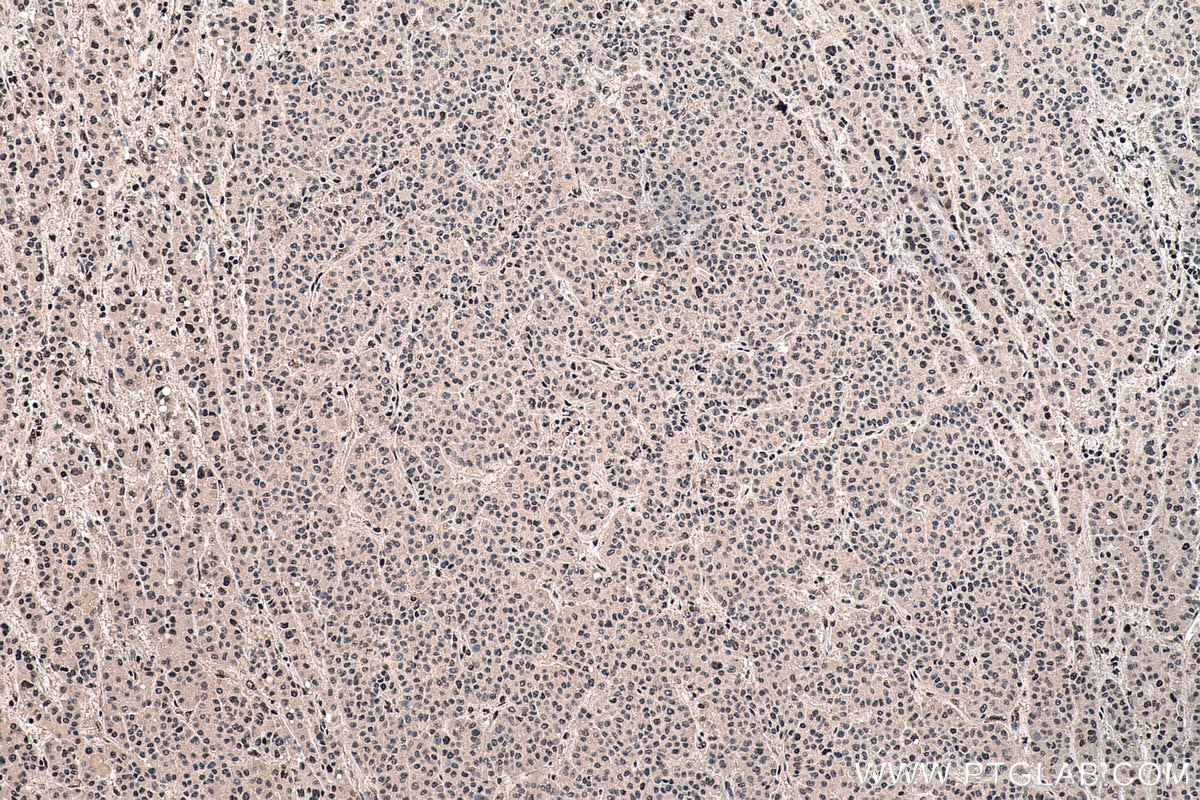 Immunohistochemistry (IHC) staining of human liver cancer tissue using FBL Monoclonal antibody (66985-1-Ig)