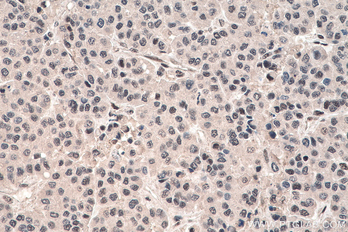 Immunohistochemistry (IHC) staining of human liver cancer tissue using FBL Monoclonal antibody (66985-1-Ig)