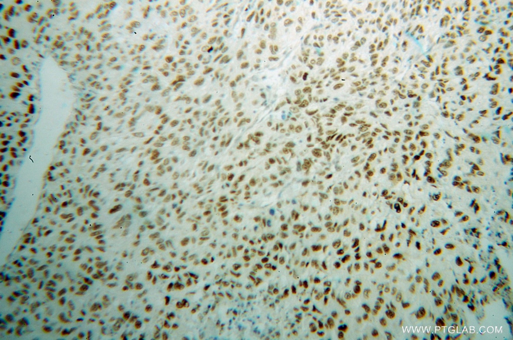 Immunohistochemistry (IHC) staining of human lung cancer tissue using FBLIM1 Polyclonal antibody (13349-1-AP)