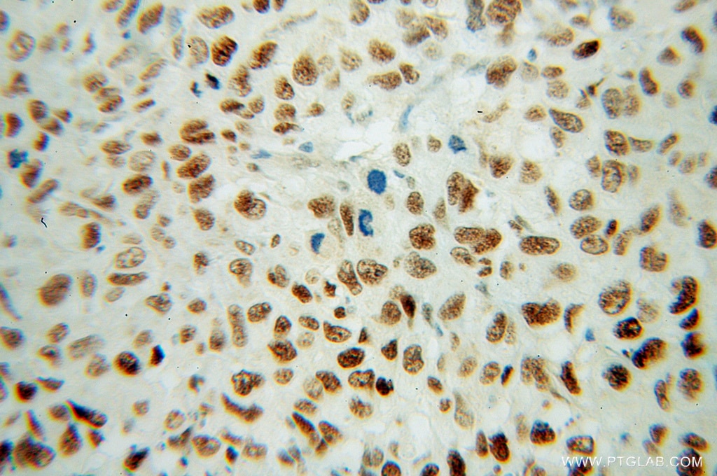 Immunohistochemistry (IHC) staining of human lung cancer tissue using FBLIM1 Polyclonal antibody (13349-1-AP)
