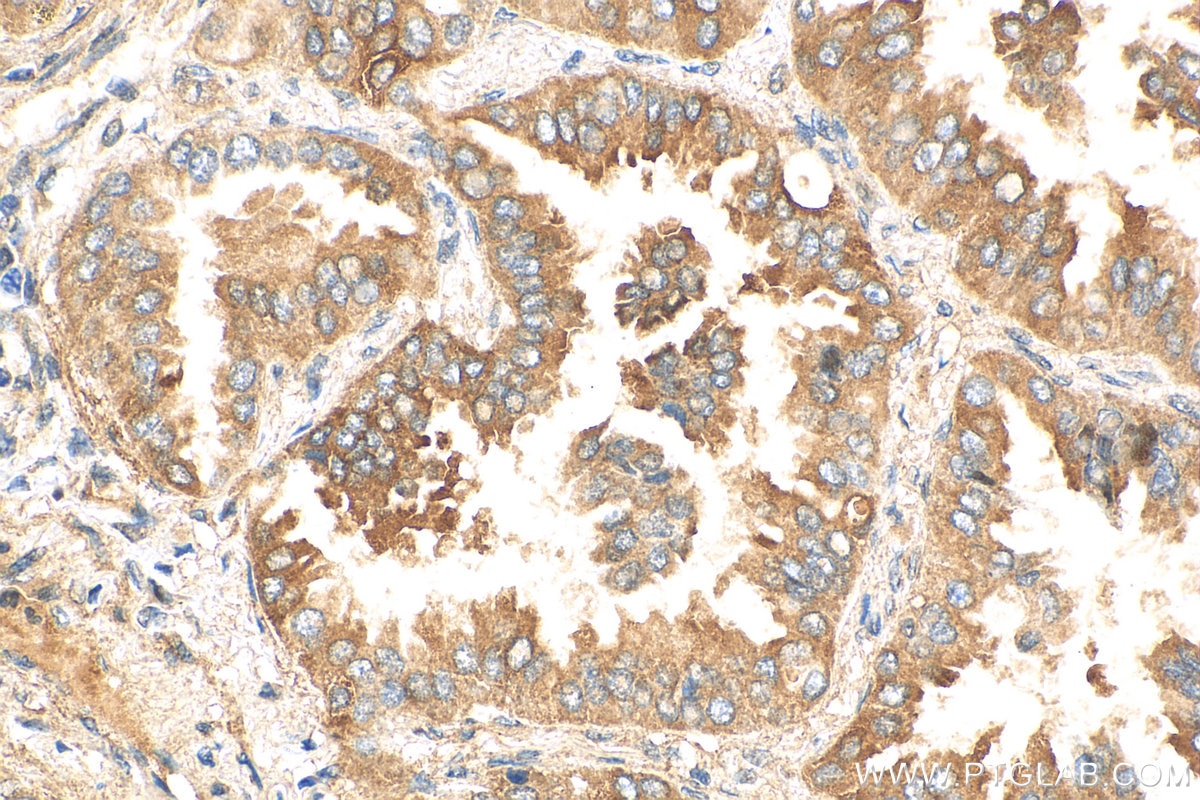 Immunohistochemistry (IHC) staining of human lung cancer tissue using Fibulin 5 Polyclonal antibody (29992-1-AP)