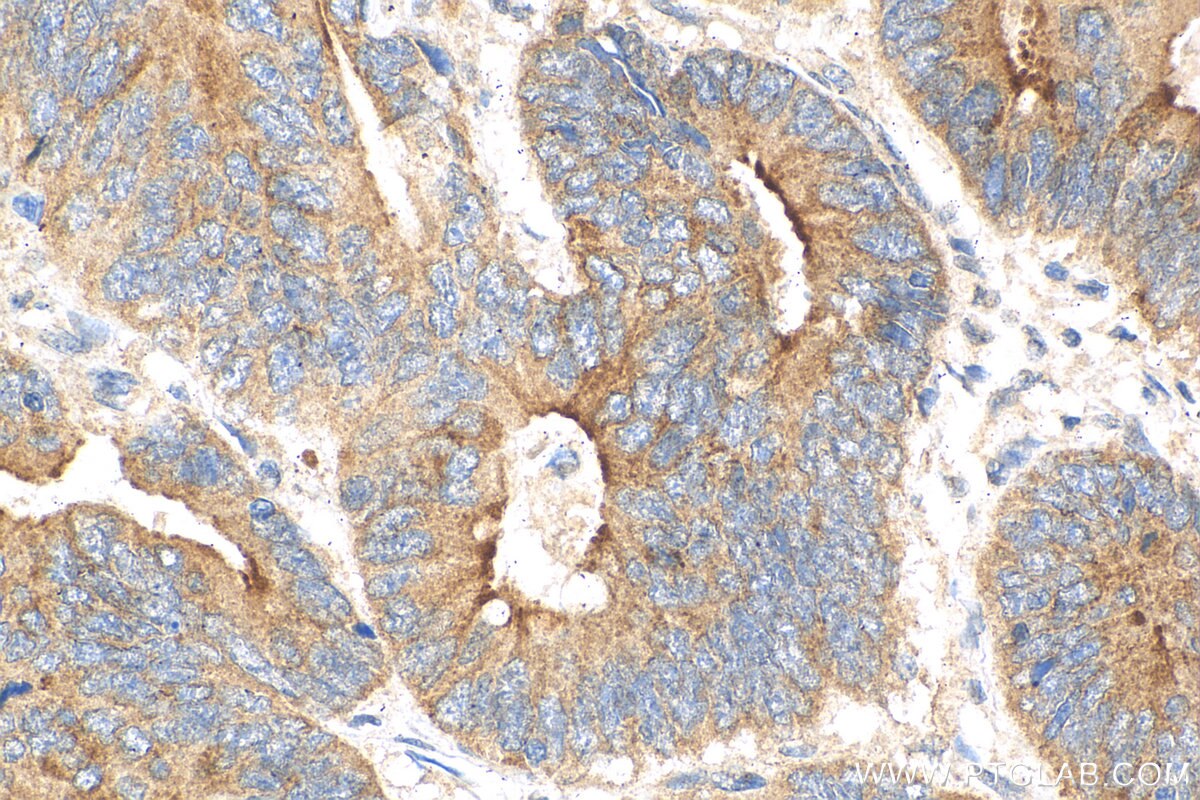 Immunohistochemistry (IHC) staining of human colon cancer tissue using Fibulin 5 Polyclonal antibody (29992-1-AP)