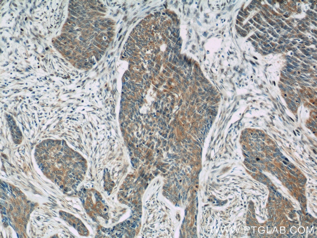 Immunohistochemistry (IHC) staining of human skin cancer tissue using FBN1-Specific Polyclonal antibody (20251-1-AP)