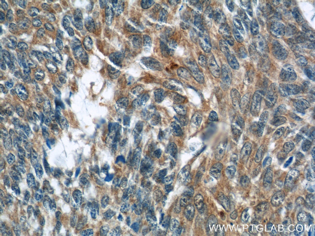 Immunohistochemistry (IHC) staining of human skin cancer tissue using FBN1-Specific Polyclonal antibody (20251-1-AP)