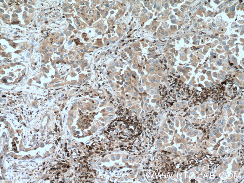 Immunohistochemistry (IHC) staining of human lung cancer tissue using FBP17 Polyclonal antibody (27056-1-AP)