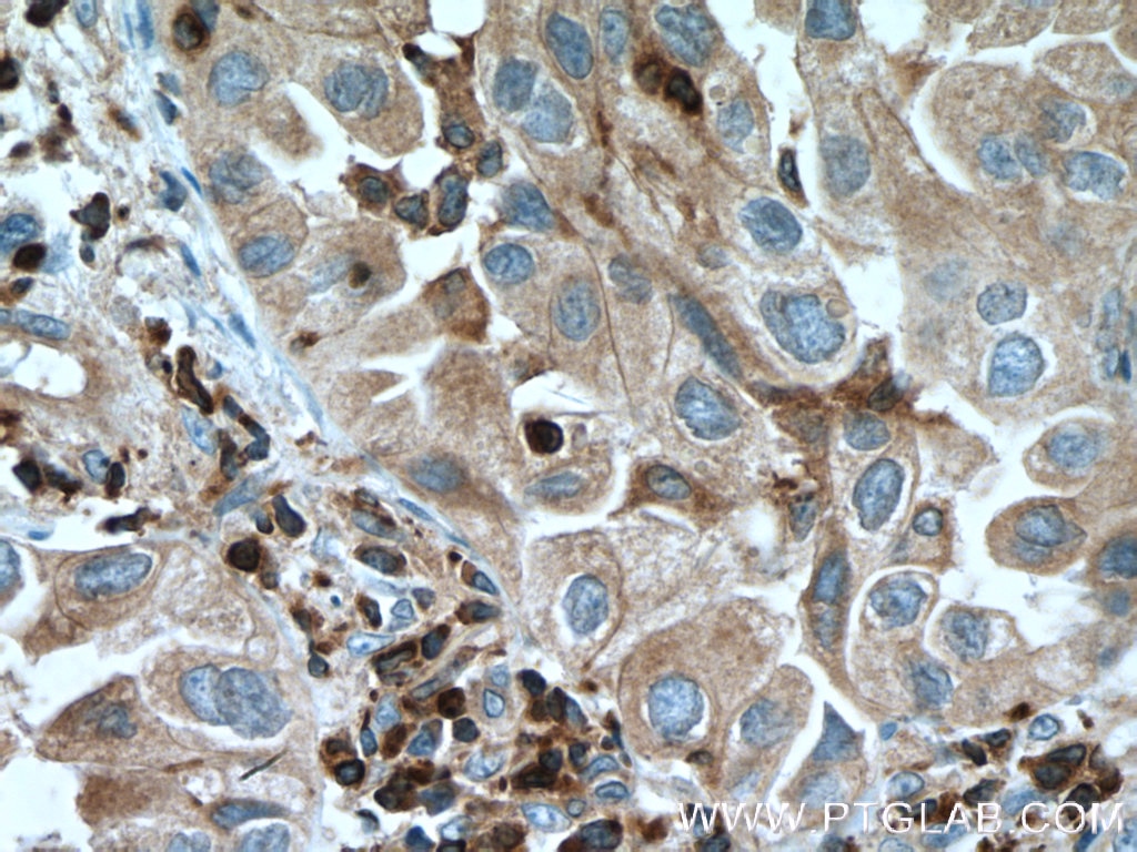Immunohistochemistry (IHC) staining of human lung cancer tissue using FBP17 Polyclonal antibody (27056-1-AP)