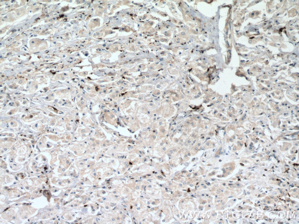 IHC staining of human breast cancer using 27056-1-AP