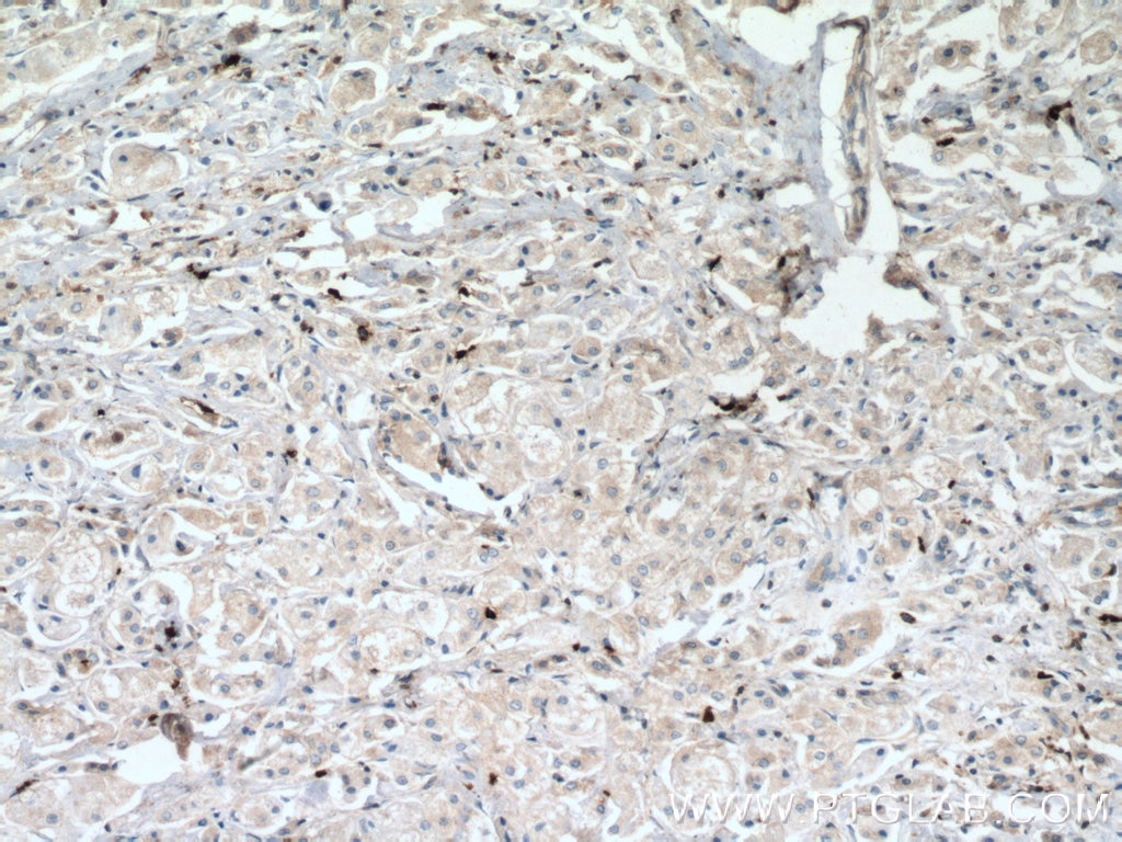 Immunohistochemistry (IHC) staining of human breast cancer tissue using FBP17 Polyclonal antibody (27056-1-AP)