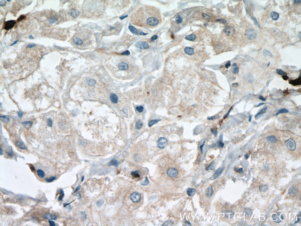 Immunohistochemistry (IHC) staining of human breast cancer tissue using FBP17 Polyclonal antibody (27056-1-AP)