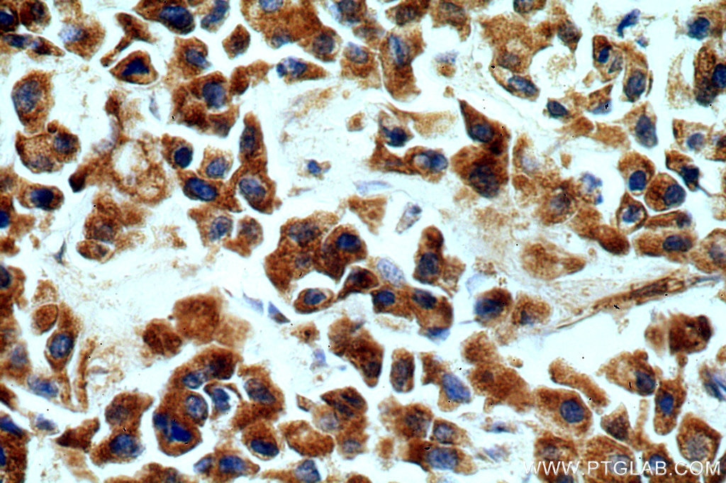 Immunohistochemistry (IHC) staining of human breast cancer tissue using fibrosin Polyclonal antibody (11356-1-AP)