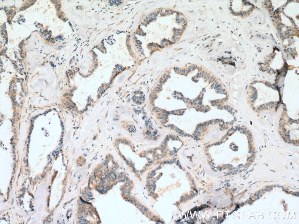 Immunohistochemistry (IHC) staining of human breast cancer tissue using FBXL15 Polyclonal antibody (20895-1-AP)