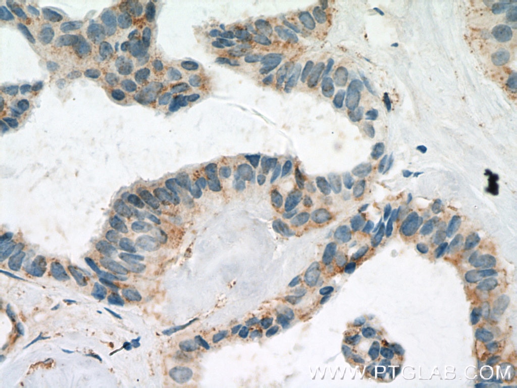 Immunohistochemistry (IHC) staining of human breast cancer tissue using FBXL15 Polyclonal antibody (20895-1-AP)