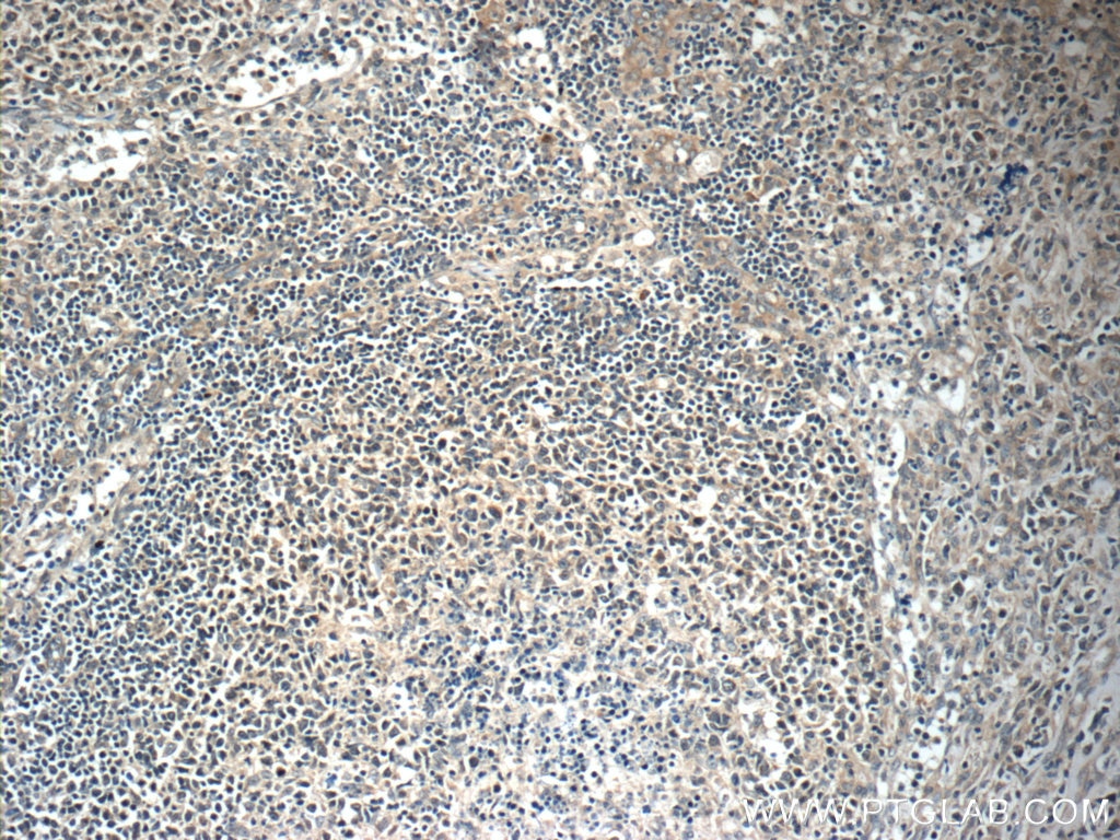 Immunohistochemistry (IHC) staining of human lymphoma tissue using FBXL18 Polyclonal antibody (11556-1-AP)