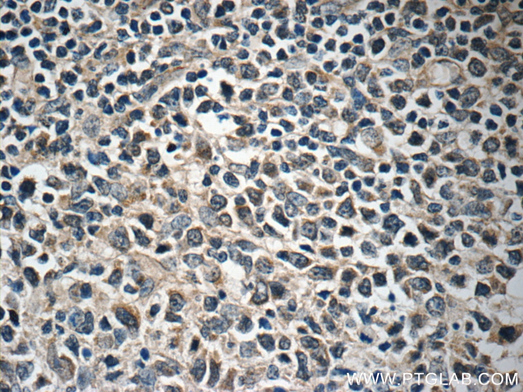 Immunohistochemistry (IHC) staining of human lymphoma tissue using FBXL18 Polyclonal antibody (11556-1-AP)