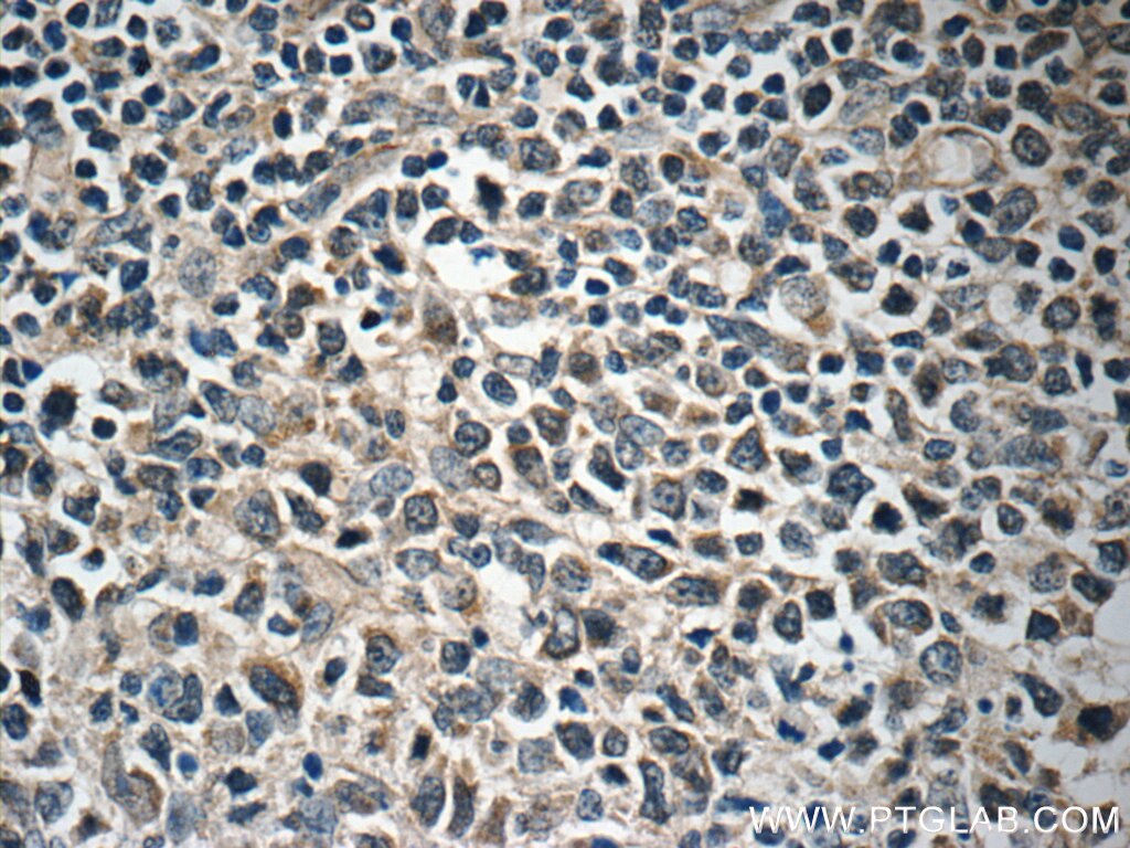 IHC staining of human lymphoma using 11556-1-AP