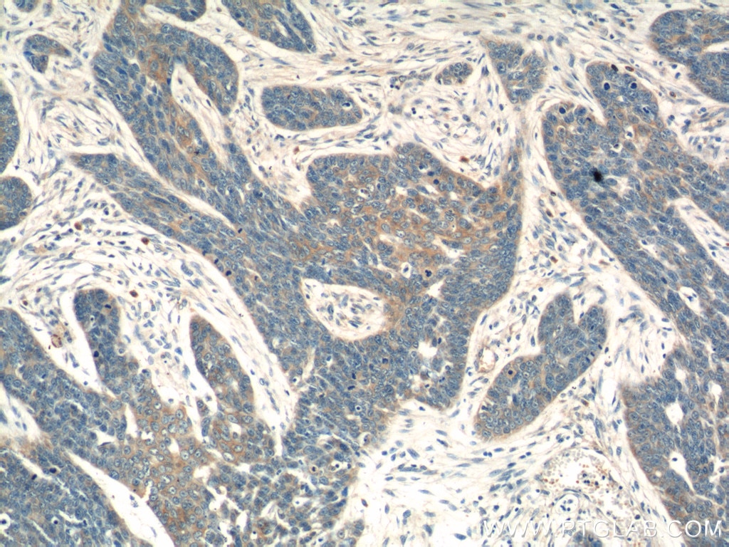 Immunohistochemistry (IHC) staining of human skin cancer tissue using FBXL18 Polyclonal antibody (11556-1-AP)
