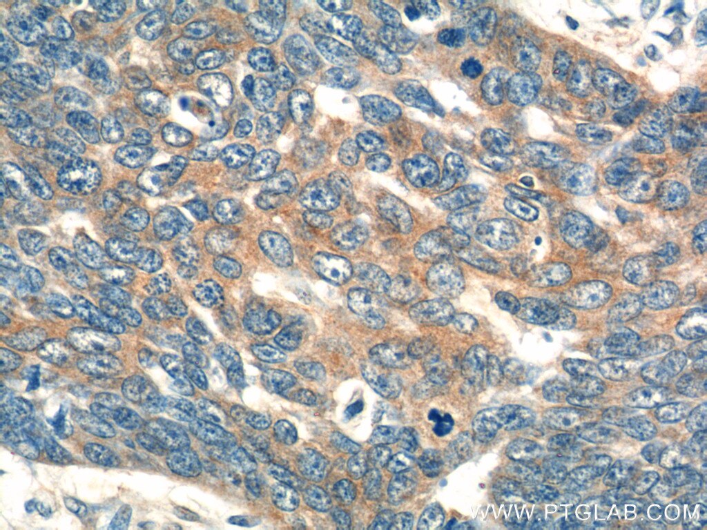 IHC staining of human skin cancer using 11556-1-AP