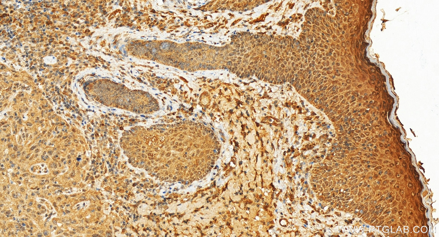 Immunohistochemistry (IHC) staining of human skin cancer tissue using FBXL18 Polyclonal antibody (11556-1-AP)