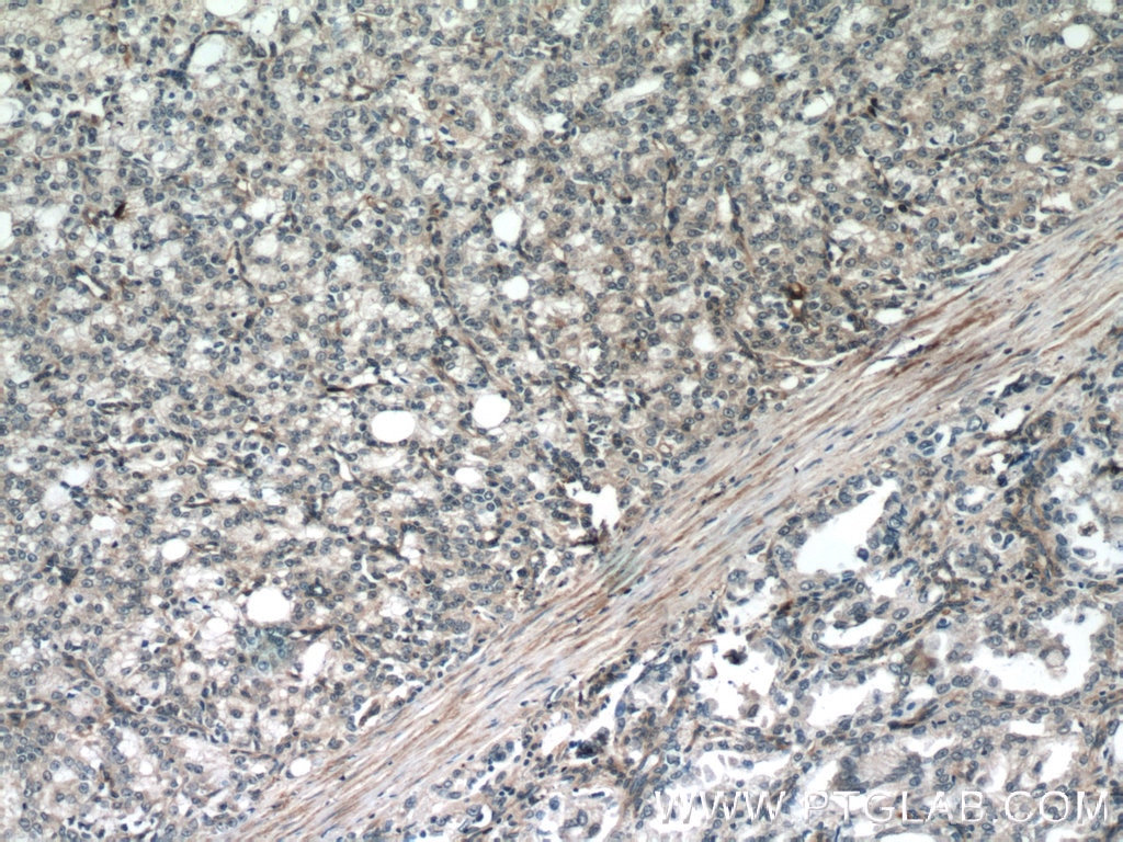 Immunohistochemistry (IHC) staining of human prostate cancer tissue using FBXO17 Polyclonal antibody (12844-1-AP)