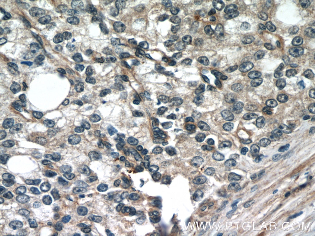 Immunohistochemistry (IHC) staining of human prostate cancer tissue using FBXO17 Polyclonal antibody (12844-1-AP)