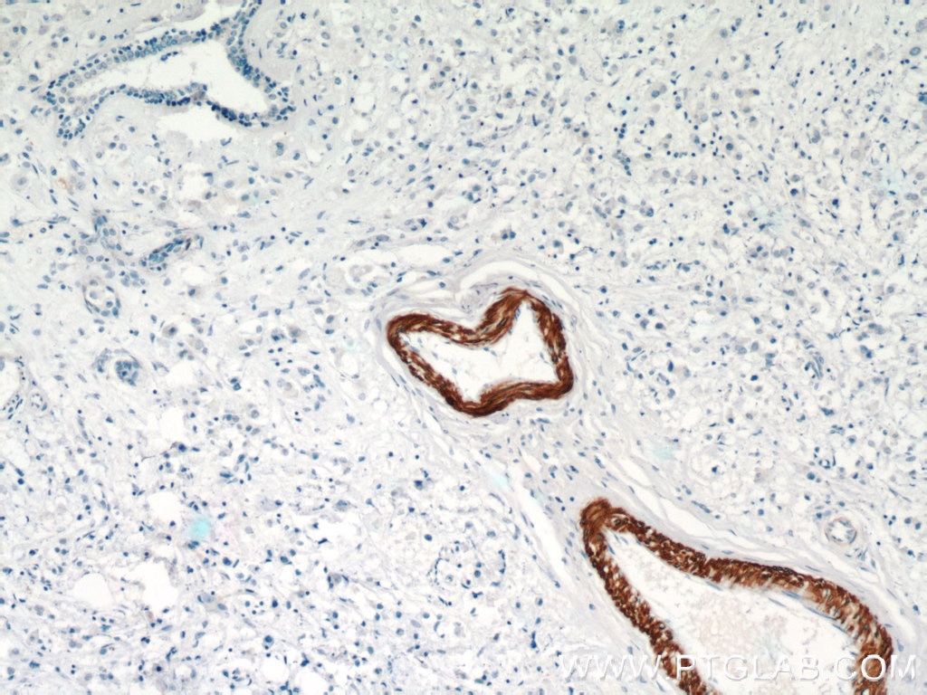 Immunohistochemistry (IHC) staining of human breast cancer tissue using FBXO28 Polyclonal antibody (24282-1-AP)