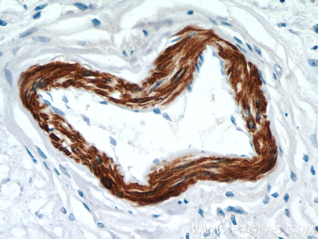 Immunohistochemistry (IHC) staining of human breast cancer tissue using FBXO28 Polyclonal antibody (24282-1-AP)