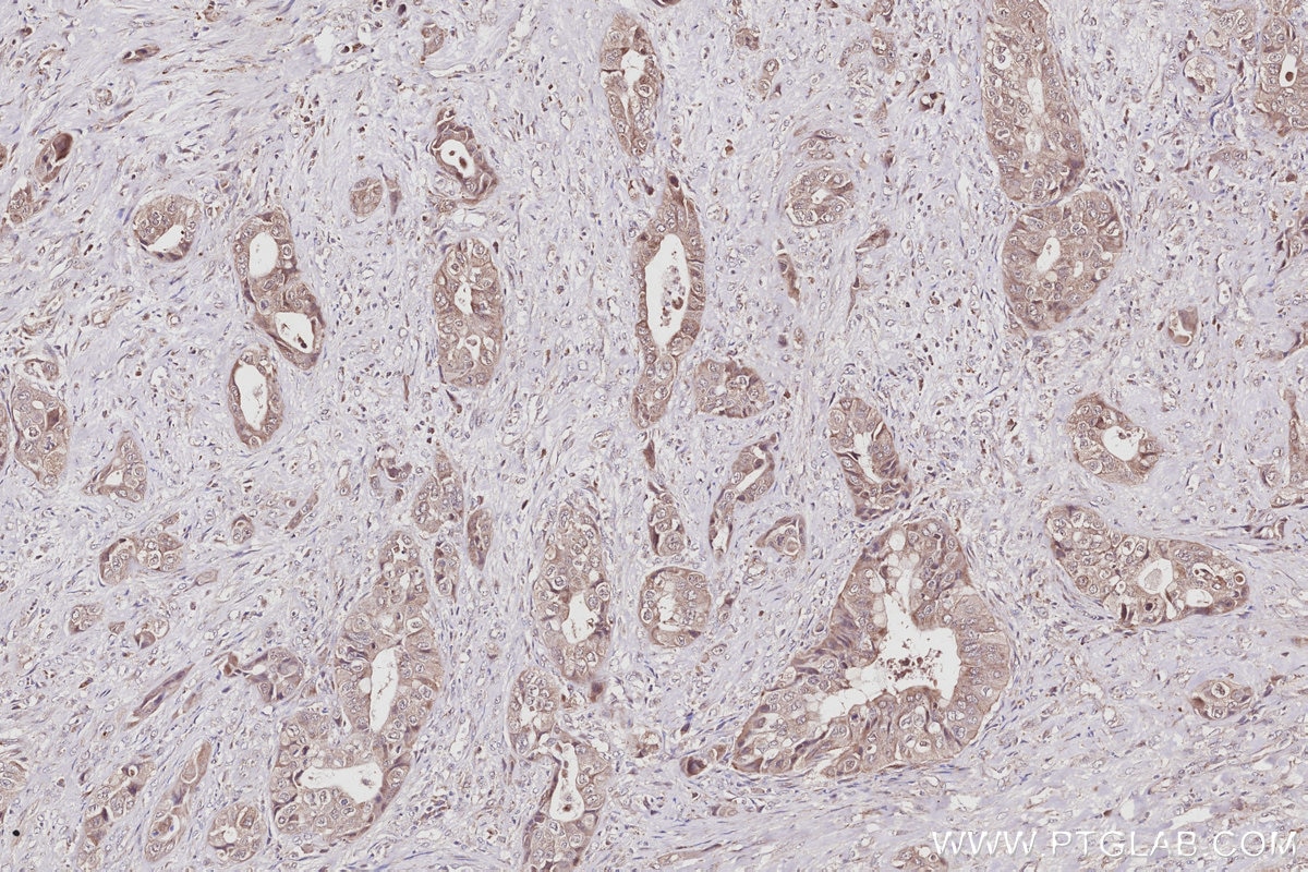 Immunohistochemistry (IHC) staining of human pancreas cancer tissue using FBX4 Polyclonal antibody (13855-1-AP)