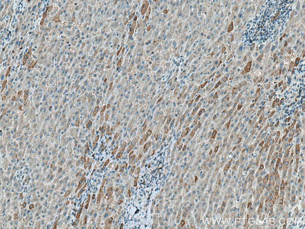 Immunohistochemistry (IHC) staining of human liver cancer tissue using FBXO44 Polyclonal antibody (10626-1-AP)