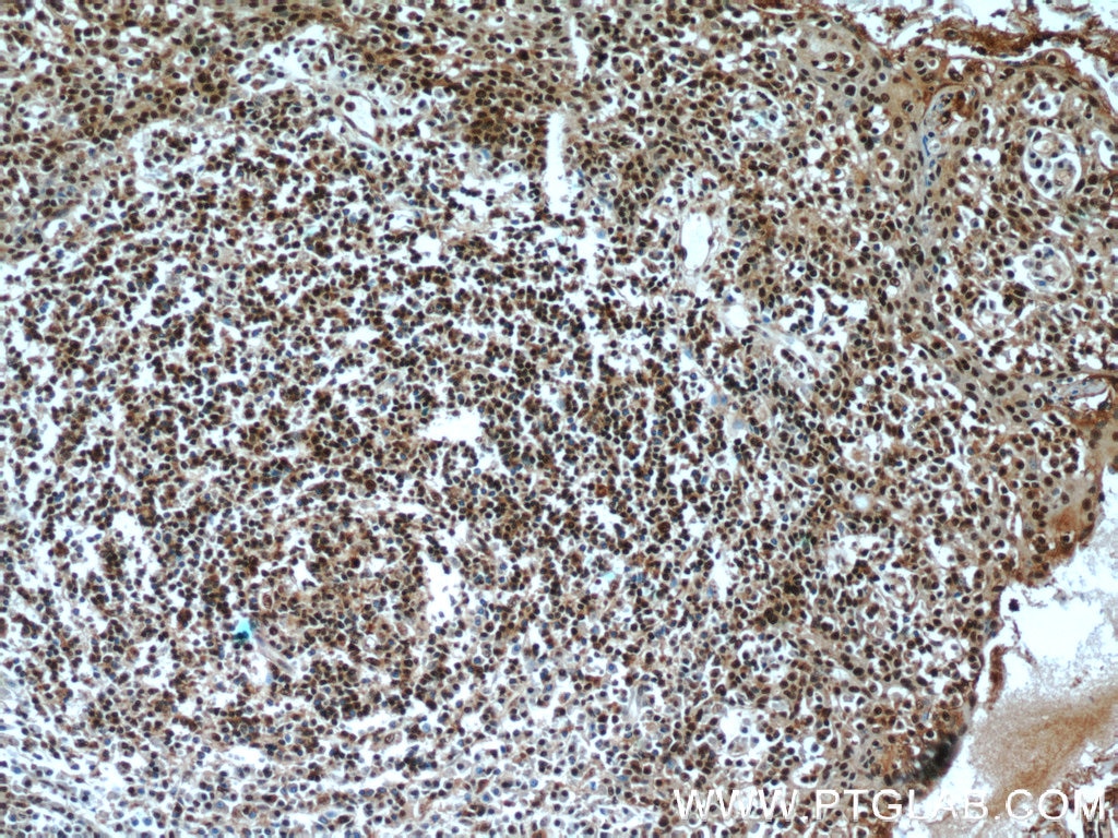 Immunohistochemistry (IHC) staining of human tonsillitis tissue using FBXO5 Polyclonal antibody (10872-1-AP)