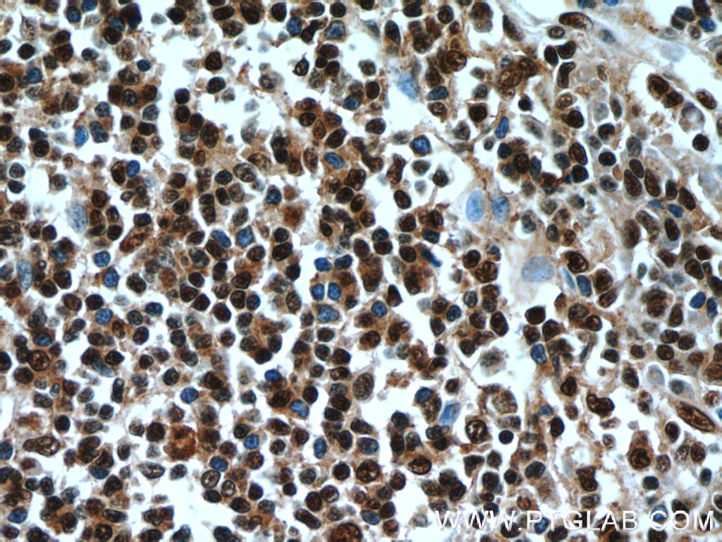 Immunohistochemistry (IHC) staining of human tonsillitis tissue using FBXO5 Polyclonal antibody (10872-1-AP)