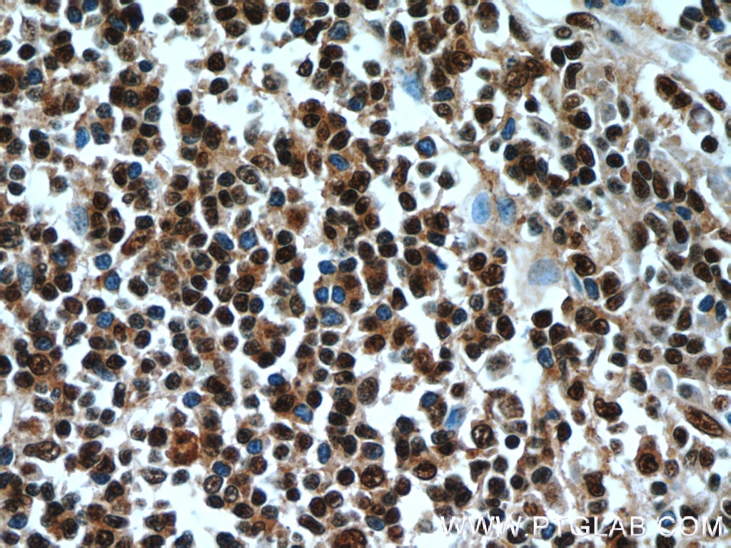 IHC staining of human tonsillitis using 10872-1-AP