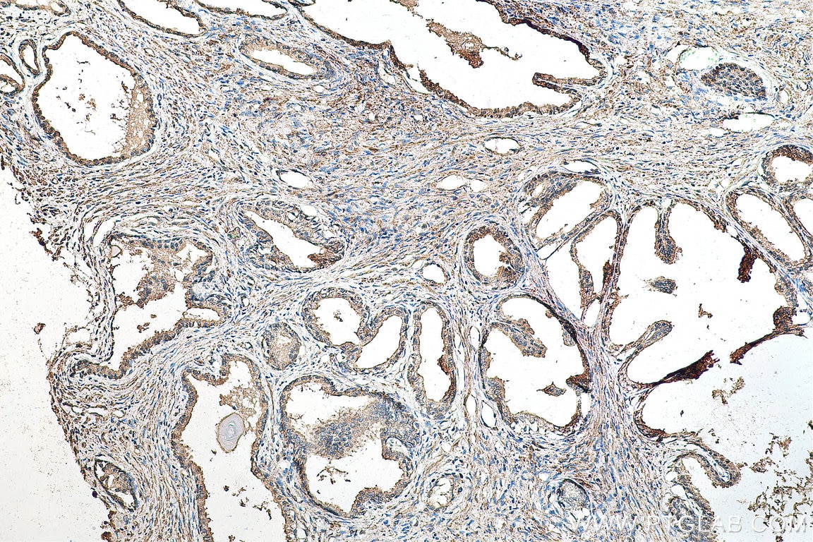 Immunohistochemistry (IHC) staining of human prostate cancer tissue using FBXO6 Polyclonal antibody (11830-1-AP)